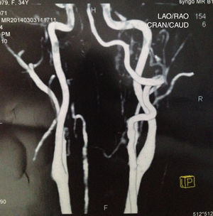 Angiorressonância demonstra falha de enchimento em artéria vertebral esquerda (visão posterior).