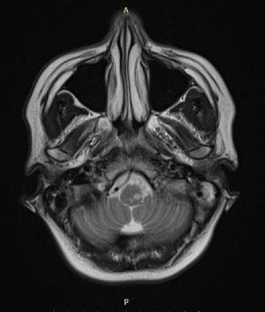 Ressonância magnética de encéfalo ponderada em T2, em corte axial, com hipersinal em região posteroinferior do bulbo.