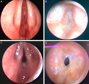 Diagnóstico topográfico de diversas lesões. (A) Estenose subglótica isolada de Grau 3; (B) Membrana glótica Tipo 4; (C) Estenose glótica posterior Tipo 4; (D) Estenose traqueal isolada cervical, moderada, 1‐3cm.