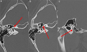 Imagens de TC do osso temporal esquerdo de uma menina de 12 anos com paralisia de Bell à esquerda. A seta indica o canal do nervo facial; (a) segmento labiríntico, (b) segmento timpânico, (c) segmento mastoideo.
