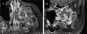 RM com contraste à base de gadolínio do Caso 2. Imagem axial (A) e coronal (B). Suspeitou‐se de um tumor vascular heterogeneamente realçado.
