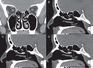 (A) Imagem de TC coronal demonstra a distância vertical do assoalho nasal (AN) até o teto do seio maxilar (SM) medial mais alto e base do crânio do etmoide posterior (EP); (B) Imagem de TC sagital demonstra distância vertical do assoalho nasal (AN) até o óstio esfenoidal OE); (C) Imagem de TC sagital demonstra a distância vertical do assoalho nasal (AN) até o teto do seio esfenoidal anterior (TE); (D) Imagem de TC sagital demonstra a distância vertical do assoalho nasal (AN) até o assoalho do seio esfenoidal anterior (AE).