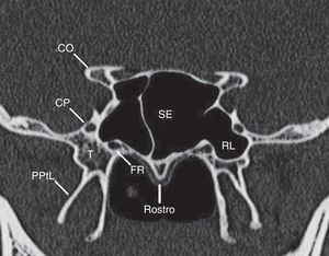 O corte coronal em que tanto o canal pterigoideo como o forame redondo são visualizados (em geral no ponto médio do seio esfenoide). SE, seio esfenoidal; FR, forame redondo; CP, canal pterigoide; PPtL, placa pterigoide lateral; CO, canal óptico; RL, recesso lateral.