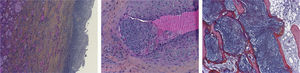 Comparação da histologia do condrossarcoma inicial (direita) e da metástase em tireoide 14 anos depois (esquerda e centro). Um laboratório especializado em sarcoma confirmou que ambas as lesões eram idênticas (Oscar Lambret de Lille, França). Esquerda: metástase em tiroide, coloração com HE×2,5; tumor mixoide que infiltra o tecido e dissociação de vesículas tireoidianas. Centro: invasão vascular na metástase em tireoide; coloração com HES×10; agrupamento de condrócitos indiferenciados em um estroma mixoide, cobertos por uma camada endotelial em lúmen de vaso. Direita: condrossarcoma de fêmur, coloração com HE×2,5, mostra reabsorção óssea maciça por um tumor condromixoide.