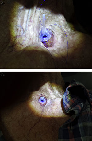 (a) Os anéis ligados aos flanges da traqueia e esôfago da prótese vocal. (b) O lado superior do flange traqueal da prótese vocal foi suturado à pele no traqueostoma com suturas 3.0 não absorvíveis.