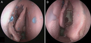 Modelo após dissecção padronizada. A, Concha média mantida sem tratamento após dissecção. B, Concha média suturada ao septo após dissecção.