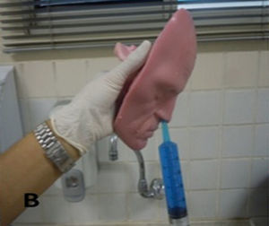 Terapia tópica de irrigação com seringa feita em posição ortostática, simula leve flexão anterior da cabeça (30°).