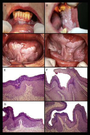 (A) Leucoplasia verrucosa proliferativa (LVP) na gengiva inferior inserida e que gradualmente se estende ao longo da crista alveolar esquerda. (B) LVP na mucosa bucal com diferentes padrões clínicos: áreas maiores de leucoplasias homogêneas e áreas com espessamento da superfície de queratinização e/ou verrugas. (C e D) LVP na parte ventral da língua e no assoalho da boca com aparência exofítica e área focal de padrão granular em ambas as cristas alveolares. (E) Imagem histopatológica mostra acantose e hiperqueratose com displasia leve. (F) Lesão exofítica, hiperqueratótica superfície verruciforme ou papilar proeminente e acantose que forma projeções rombas na lâmina própria. (G) Hiperqueratose, acantose, irregularidade da camada basal e algumas áreas de atrofia epitelial. (H) Hiperqueratose com projeções epiteliais em forma de gota e lâmina própria intacta (HE, ampliação original 40x).