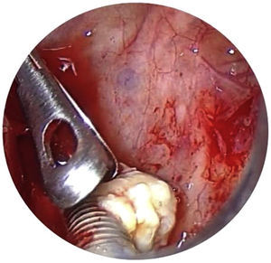 Visualização de implante dentário por trocarte com endoscópio de 0°.