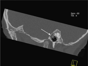 TCMD sagital do osso temporal esquerdo, no nível do cabo do martelo, mostra a massa de tecido mole no ático e antro (seta).
