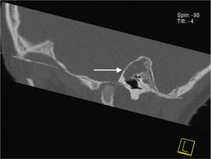 Imagem sagital do osso temporal esquerdo mostra a massa de tecido mole na região do ático e antro, e mesotímpano aerado.