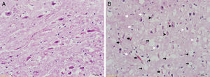 Exame histomorfológico com coloração H&E (40x); (A) Grupo Controle: integridade tecidual, a aparência geral de células é natural, sem mudanças no tamanho do neurônio. (B) Grupo RF‐EMF: há degeneração de neurônios no núcleo coclear ventral, degradação (setas pretas), além de alguma diminuição no tamanho de neurônios, células picnóticas encolhidas (cabeças de setas brancas). Aumento do número de células gliais (setas brancas) e áreas com aumento da vascularização (setas pretas). Vacuolização intensa no tecido (setas pretas finas) e áreas edematosas.