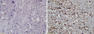 Resultados da coloração por Tunel; (A) Grupo Controle; (B) Grupo de Estudo: células apoptóticas (cabeças de setas pretas), neurônios picnóticos (setas pretas), áreas vacuolizadas difusas (setas brancas).