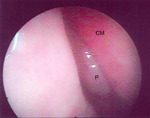 Imagem da endoscopia de um pólipo Grau I na cavidade nasal direita do paciente n° 12 (P, pólipo; CM, concha média nasal).