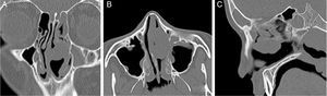Lesão de massa homogênea com aumento de contraste e origem na concha média esquerda em imagens de tomografia computadorizada coronal (A), axial (B) e sagital (C).