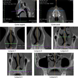 Planos sagital e axial usados para protocolo para planos coronais reformatados (larguras 1–5). Larguras 1 e 2 – cabeça do corneto inferior; larguras 3 e 4 – cabeça do corneto médio; largura 5 – osso maxilar.