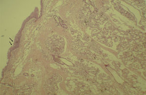Mucosa do seio maxilar mostra áreas de erosão no epitélio (setas) e células inflamatórias. Microscopia óptica, coloração HE, 100×.