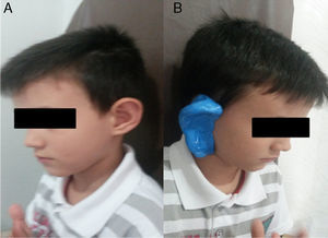 (A) Paciente com deformidade auricular tipo V de Tanzer. (B) Pré‐moldagem feita na orelha direita do paciente.