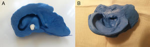 (A) Contramolde feito de silicone da orelha de um paciente com orelhas proeminentes. (B) Modelo da aurícula direita, feito com a aplicação de resina no contramolde.