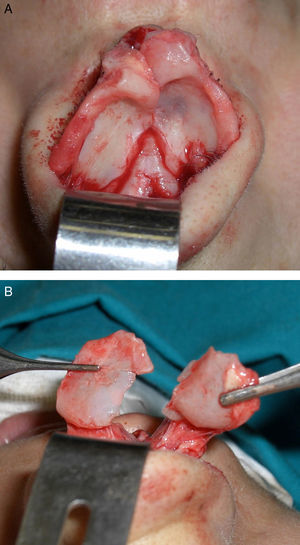(A) Exposição de cartilagem alar após execução da técnica aberta. (B) Corte bilateral da porção posterior da cartilagem.