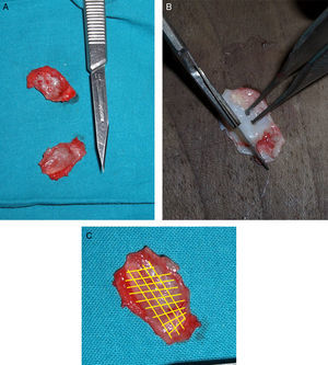 (A) Imagens de cartilagens destacadas do ponto original. (B) Remodelação da cartilagem para obter a anatomia correta. (C) Esquema de linhas de fragilização.