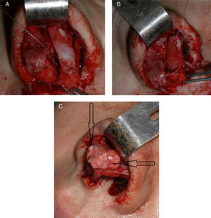 (A) Sutura da porção anterior da cartilagem alar. (B) Sutura da porção posterior da cartilagem alar. (C) Aposição do enxerto columelar para definir a ponta, as setas mostram em detalhe as posições das suturas.