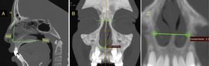 (A) Medida da altura nasal (N‐ANS) e comprimento total (ANS‐PNS) no corte sagital. (B) Medida da altura da abertura piriforme no corte coronal. (C) Medida da largura da abertura piriforme no corte coronal.
