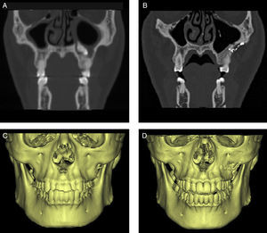 Imagens de TC e reconstrução em 3D do método de reimplante da parede óssea. A e C, pré‐operatório; B e D, imagens pós‐operatórias mostram a forma normal e sem reabsorção óssea.