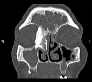 Tomografia Computadorizada (TC) de seios paranasais ‐ osteoma fronto‐etmoidal medindo aproximadamente 39,5 × 19,8 × 19,4 mm, plano coronal.
