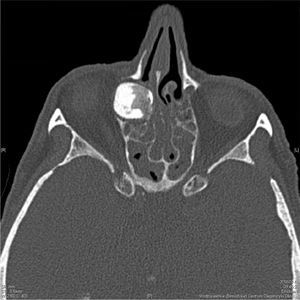 TC de seios paranasais ‐ osteoma fronto‐etmoidal, plano axial.