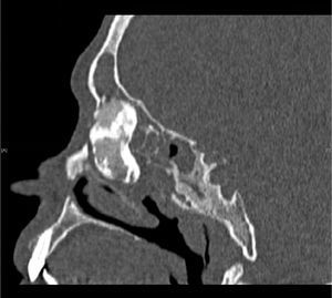 TC de seios paranasais ‐ osteoma fronto‐etmoidal gigante, plano sagital.