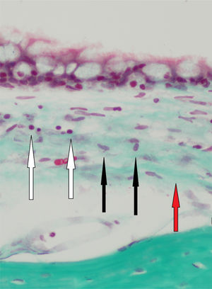 Inflamação moderada (setas brancas), atividade fibroblástica leve (setas pretas) e fibrose leve (seta vermelha) em um dos ratos do Grupo B (40 dias) (Tricrômico 400 ×).