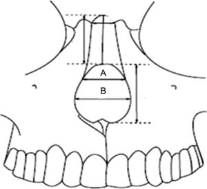 A, medida da abertura piriforme na junção dos ossos próprios do nariz com o processo frontal da maxila. B, maior diâmetro transversal da abertura piriforme.