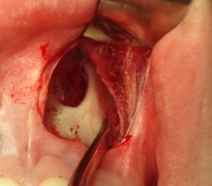 Descolamento subperiostal da abertura piriforme esquerda.