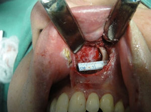 Porção inferolateral esquerda da abertura piriforme após remoção com broca.