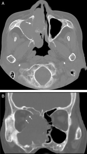 (A) A TC axial mostra a lesão de tecido mole no seio paranasal e na cavidade nasal. A destruição óssea da parede medial do seio maxilar é aparente e a margem é obscura (seta branca em A). Presença de calcificação irregular na lesão (seta preta em a). (B) A TC coronal mostra que o corpo principal da lesão está no seio etmoidal e na cavidade nasal e afeta a lâmina óssea orbitária direita com compressão do reto medial (seta branca em B). A parede óssea do seio etmoidal direito, o seio maxilar direito e o seio frontal direito encontram‐se comprometidos.