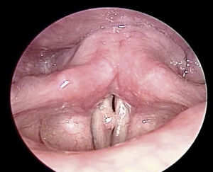 Achado em laringoscopia indireta no pré‐operatório: lesão tumoral branca estava presente na prega vocal direita, com cobertura mucosa e borda difusa, o que impossibilitava o fechamento da glote durante a fonação.