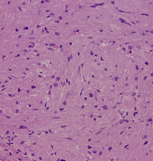 O tumor era composto por células arredondadas ou poligonais, com abundância de citoplasma granular eosinofílico e núcleos pequenos uniformes dispostos em padrões planos e de ninho. (H&E, 400×).