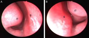 Achados pré‐operatórios da endoscopia nasal demonstram aumento da concha inferior esquerda. (A) Lado direito; e (B) lado esquerdo da cavidade nasal (S, septo nasal; IT, concha inferior).