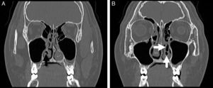 Imagens de tomografia computadorizada (TC) do paciente. (A, B) Imagens coronais de TC demonstram pneumatização de ambas as conchas inferiores e hipertrofia da concha inferior esquerda (seta preta, concha bolhosa inferior (CBI) direita; setas brancas, CBI esquerda).