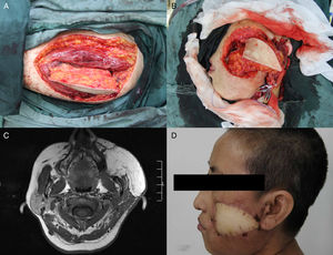 (A) O retalho ALT foi colhido da coxa esquerda; (B) Defeito com passagem de um lado a outro na face esquerda após a excisão do carcinoma de células escamosas bucais; (C) RM axial pós‐operatória mostra o retalho ALT; (D) Resultado pós‐operatório quatro meses após a cirurgia.