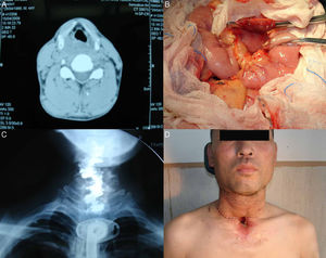 (A) Imagem pré‐operatória do câncer hipofaríngeo por TC; (B) O retalho de jejuno livre foi colhido do antebraço esquerdo; (C) Exame de contraste com bário mostra o resultado pós‐operatório; (D) Resultado pós‐operatório dois meses após a cirurgia.