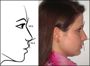 Vista lateral: ângulo nasofrontal (NFA), ângulo nasolabial (NLA). Figura da esquerda: modelo esquemático. Figura da direita: uma das voluntárias do estudo.