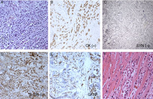 Histopatologia e coloração imuno‐histoquímica, carcinoma histiocitoide de glândula exócrina: (A) Cordões e pequenos ninhos de células histiocitoides; células tumorais positivas para citoqueratinas (B) e negativas para sinaptofisina (C); as células tumorais positivas para S‐100 (D) e algumas células são positivas para GFAP (E). Os cordões de células histiocitoides separaram fibras musculares (F).