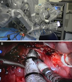 Intraoperatório. (A), Posicionamento dos braços robóticos e óptica; (B) Aspecto da ferida operatória após a laringectomia supraglótica.