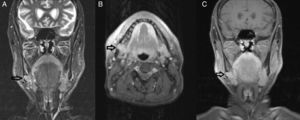 Imagens de ressonância magnética de massa lobulada na região submandibular direita (setas pretas) em secções ponderadas em T1A (A) e em secções ponderadas em T2 com supressão de gordura (B e C).