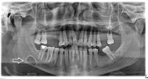 Radiografia panorâmica. Lesão cística de forma oval, bem delimitada (seta branca) entre o segundo molar e o ângulo mandibular, ligeiramente acima da linha mandibular inferior.