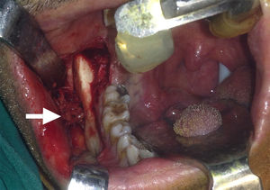 Foto intraoperatória de massa lobulada (seta branca) visualizada por meio de janela aberta na parede mandibular do cisto de Stafne.