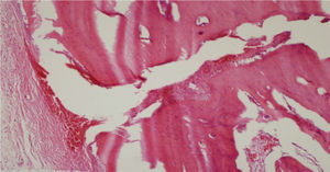 Tecido fibroso e proliferação da cartilagem na linha de fratura (H&E ×40).