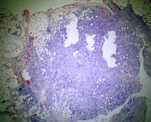 Corte histológico do depósito de tecido mole. Observa‐se massa nodular irregular composta por células tumorais malignas que infiltram o tecido lipomatoso (H&E, ×40).